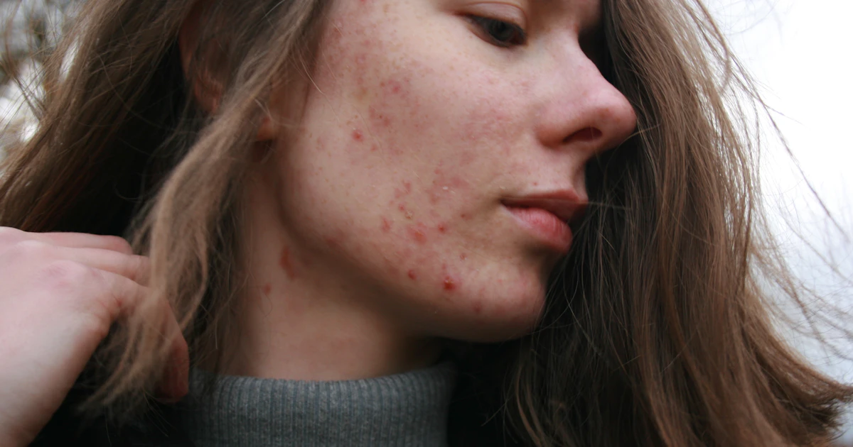 Pele com acne adulta, textura e marcas visíveis em retrato com luz natural.